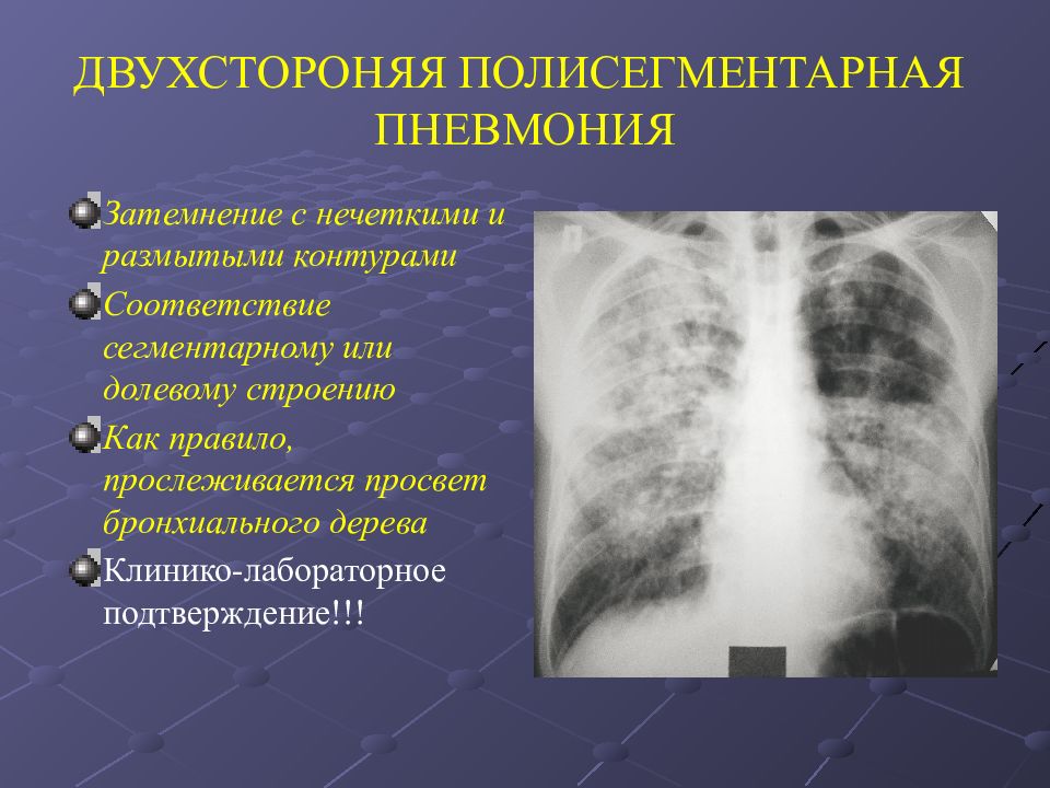Пневмония легких опасно. Двухсторонняя полисегментарная пневмония кт1. Левосторонняя полисегментарная пневмония рентген. Интерстициальная пневмония. 2 Х сторонняя полисегментарная пневмония рентген.
