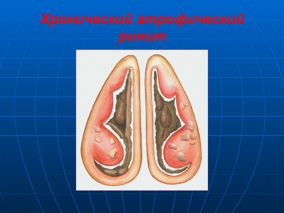 Хронический ринит презентация