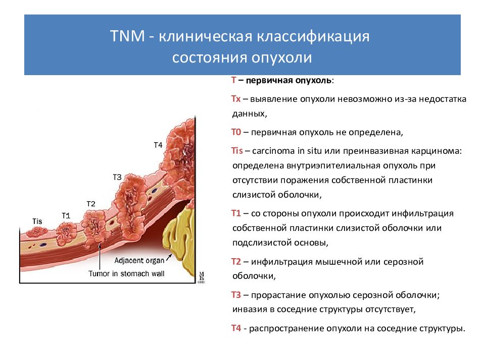 Рак желудка презентация терапия