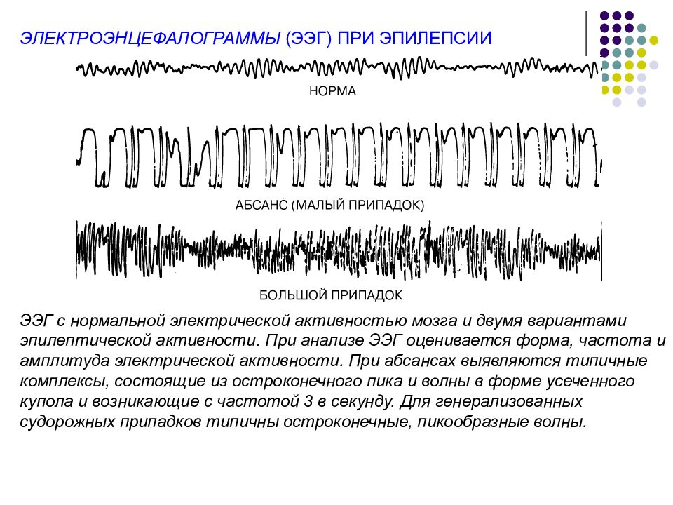 Ээг показывает эпилепсию. ЭЭГ головного мозга больного эпилепсией. ЭЭГ при фокальной эпилепсии. ЭЭГ при генерализованной эпилепсии. ЭЭГ различных эпилептических припадков..