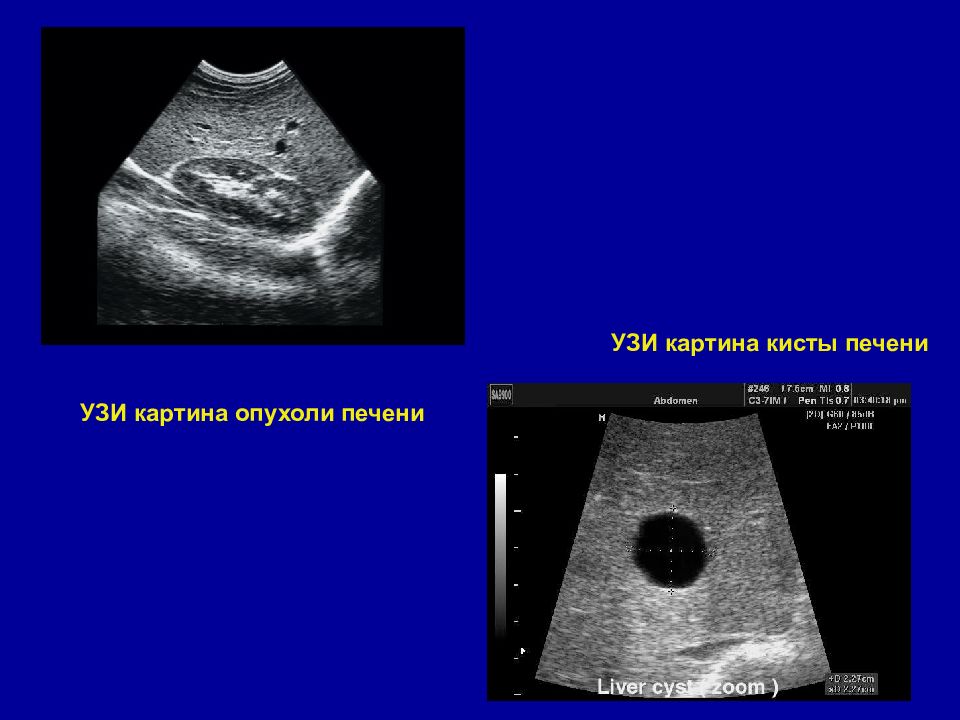 Рак печени узи картина