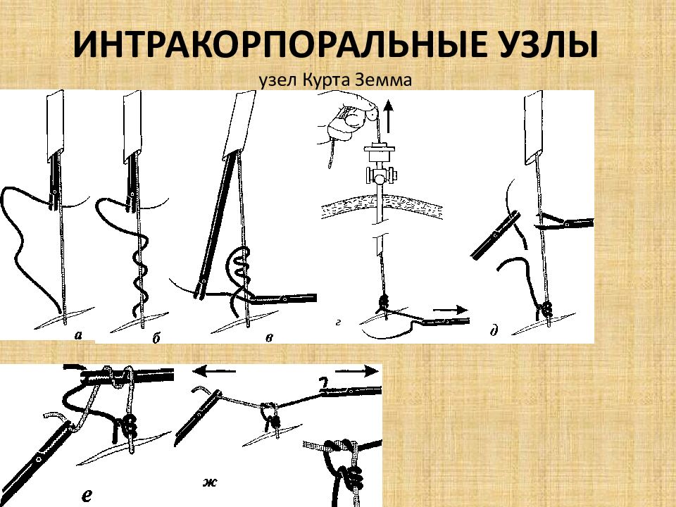 Формирование узлов. Интракорпоральный узел. Экстракорпоральный шов. Интракорпоральный эндоскопический шов. Экстракорпоральный шов в лапароскопии техника.