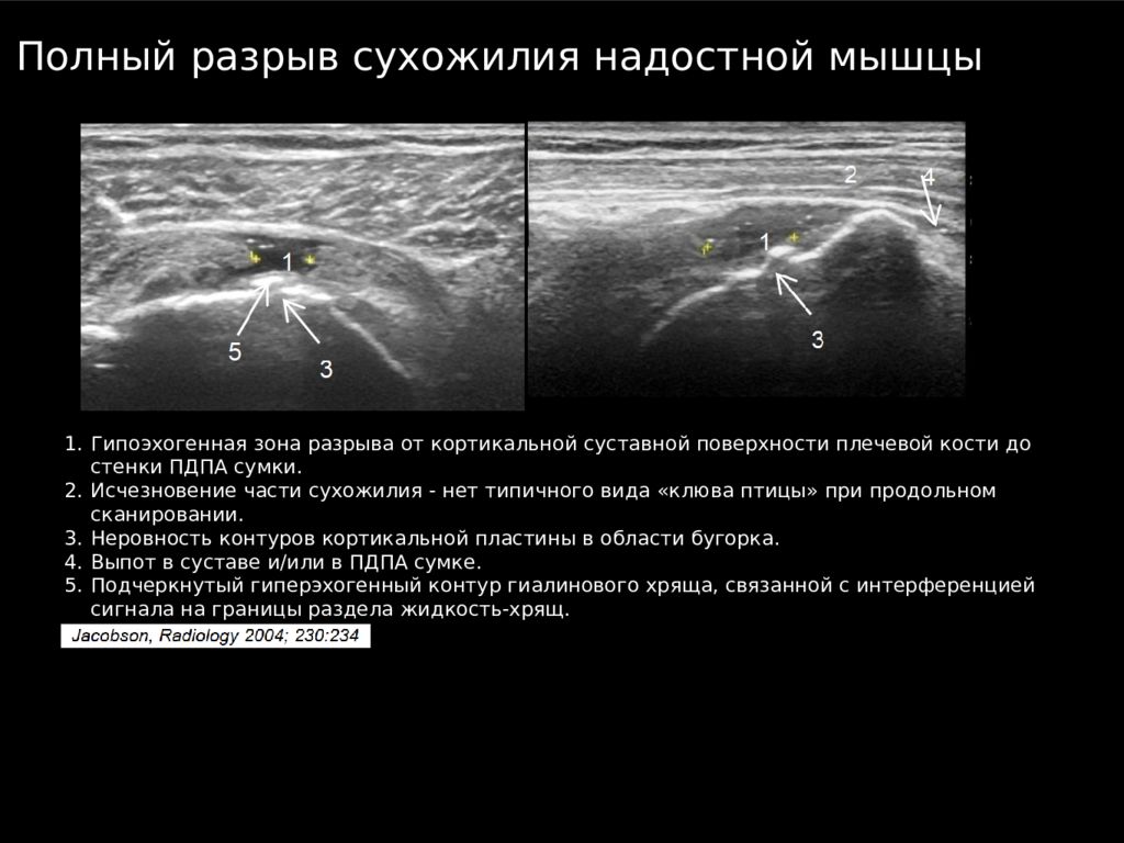 Узи плечевого. Ультразвуковая анатомия плечевого сустава. УЗИ анатомия плечевого сустава. УЗИ суставов плечевого сустава. Повреждение надостной мышцы на УЗИ.