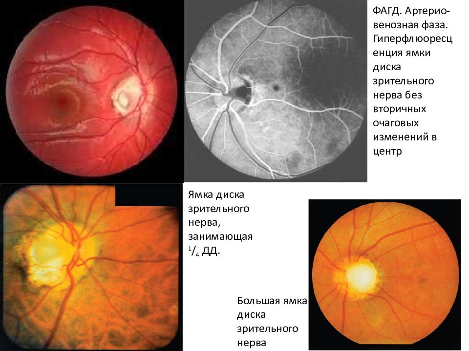 Диск зрительного нерва. Ямка ДЗН зрительного нерва. Ямка диска зрительного нерва. Ямка диска зрительного нерва на окт.
