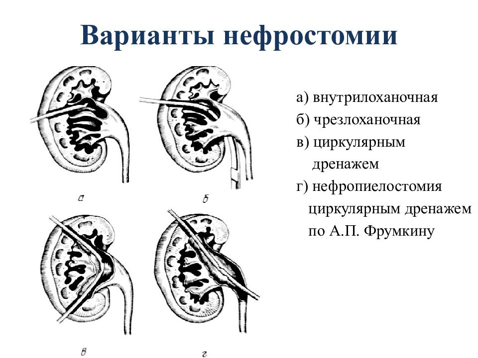 Нефростома это. Нефростомия Оперативная хирургия. Нефростомия техника операции. Нефростомия почки Оперативная хирургия. Пункционная нефростомия.