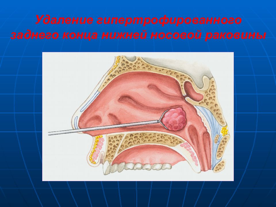 Риниты лор презентация