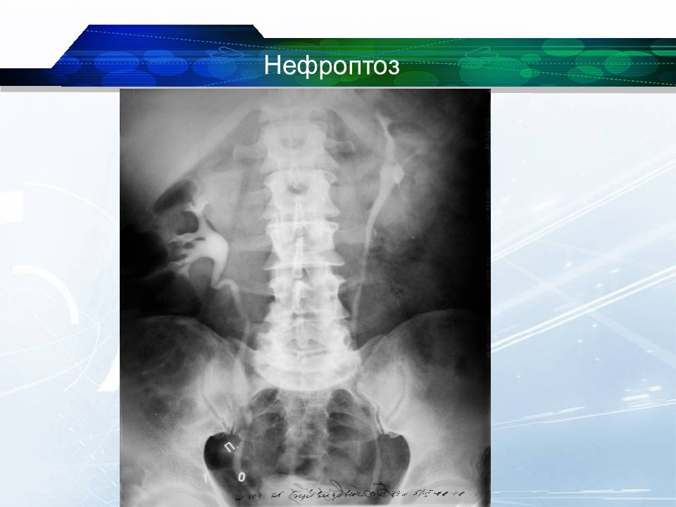 Нефроптоз это. Нефроптоз рентгенограмма. Рентгенодиагностика нефроптоза.