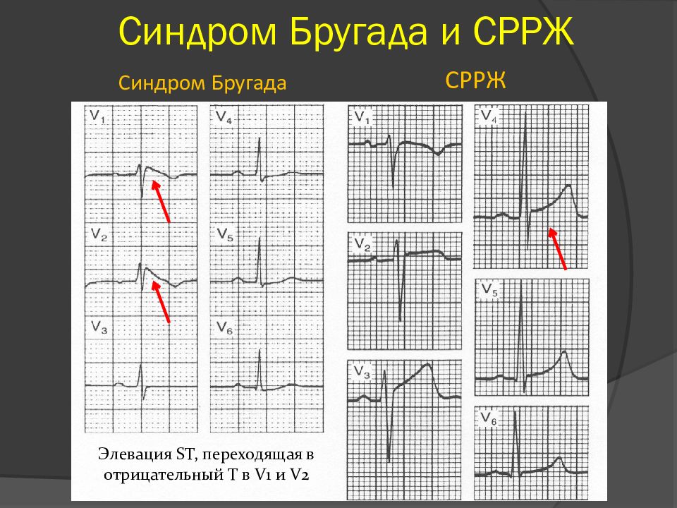 Синдром бругада презентация