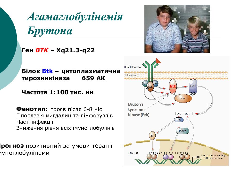 Болезнь брутона. Агаммаглобулинемия Брутона. Синдром Брутона патогенез. Патогенез агаммаглобулинемии Брутона. Агаммаглобулинемия болезнь Брутона.