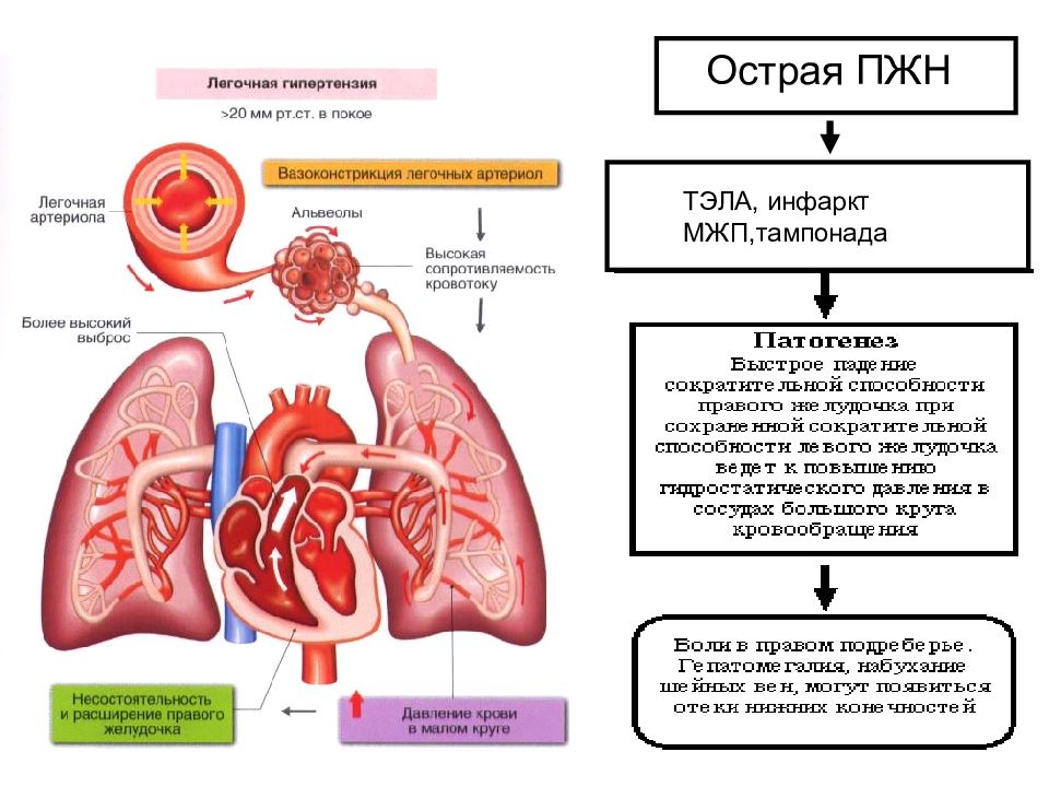 Легочная гипертензия картинки