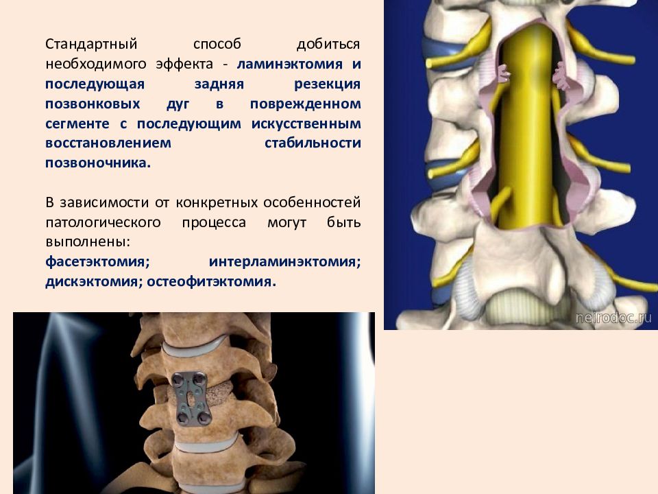 Стеноз позвоночника поясничного. Ламинэктомия поясничного отдела позвоночника. Ламинэктомия грудного отдела позвоночника. Schizas стеноз позвоночного канала. Стеноз позвоночного канала l2-l4.