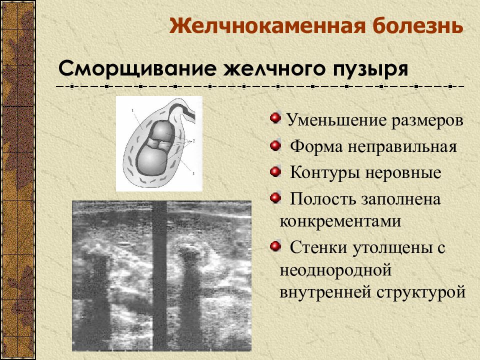 Влияет ли химический состав конкремента желчного пузыря на ультразвуковую картину конкремента тест