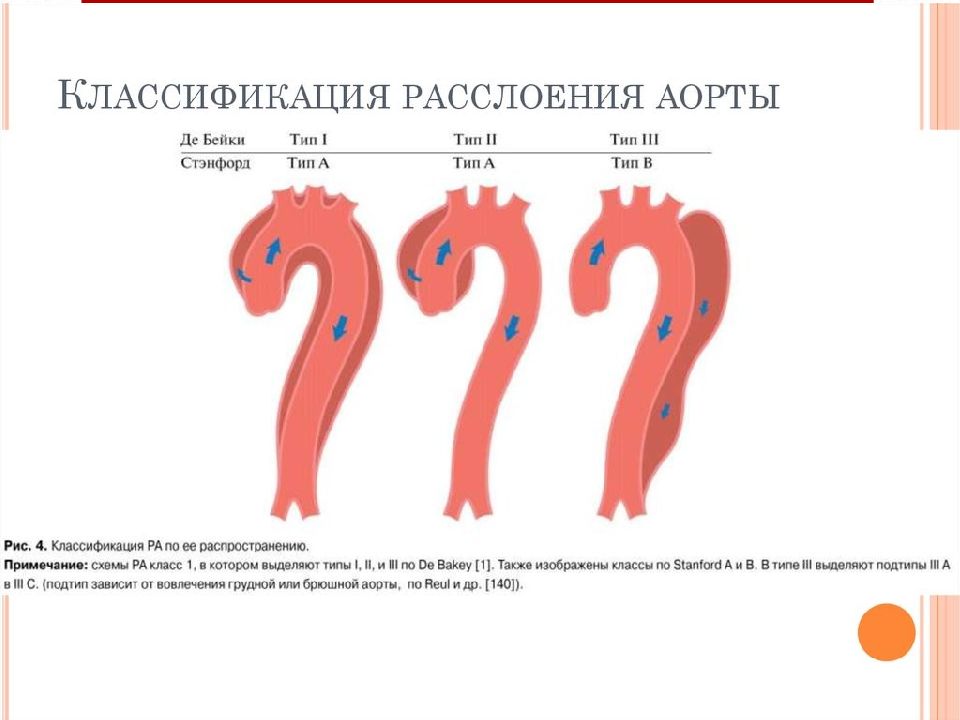 Аневризмы аорты презентация