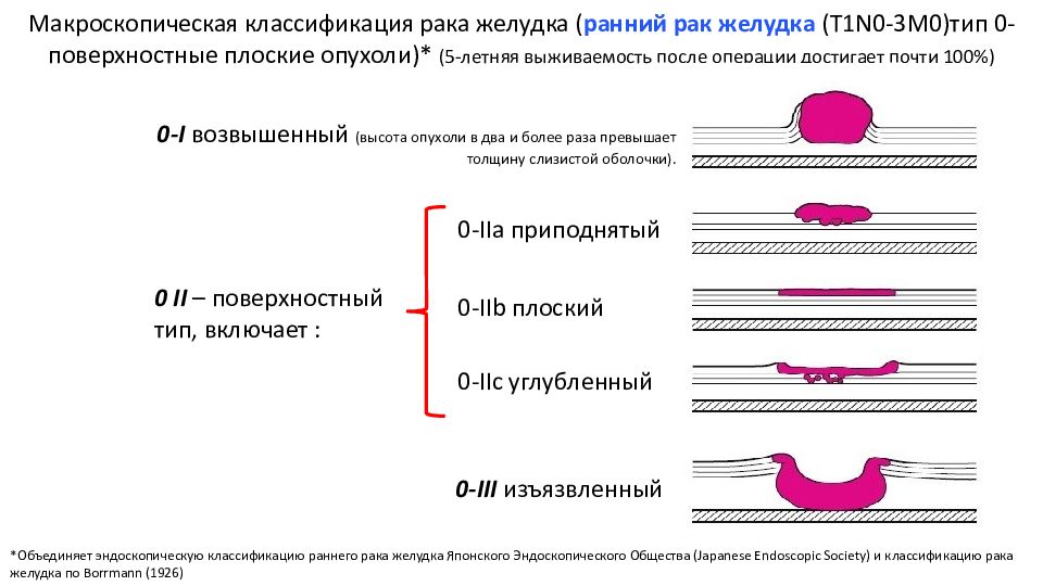 Выживаемость после операции желудка. Морфологическая классификация опухолей желудка. Эндоскопическая классификация эпителиальных новообразований ЖКТ. Парижская классификация опухолей желудка. Гистологическая классификация опухолей желудка.