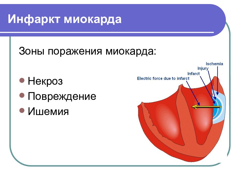 Сердце при инфаркте миокарда. Звенья патогенеза инфаркта миокарда. Основа миокарда. Механизм инфаркта миокарда патофизиология. Как записать экг но слепаку.
