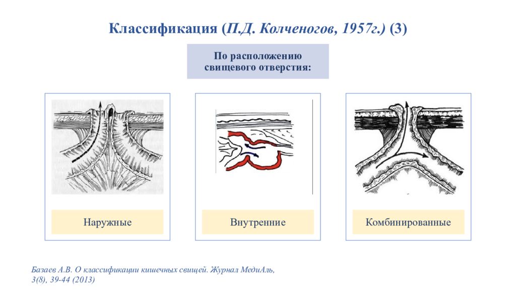 Сформированные свищи. Кишечные свищи классификация. Несформированные кишечные свищи. Полный и неполный кишечный свищ. Свищи кишечные внутренние и наружные.