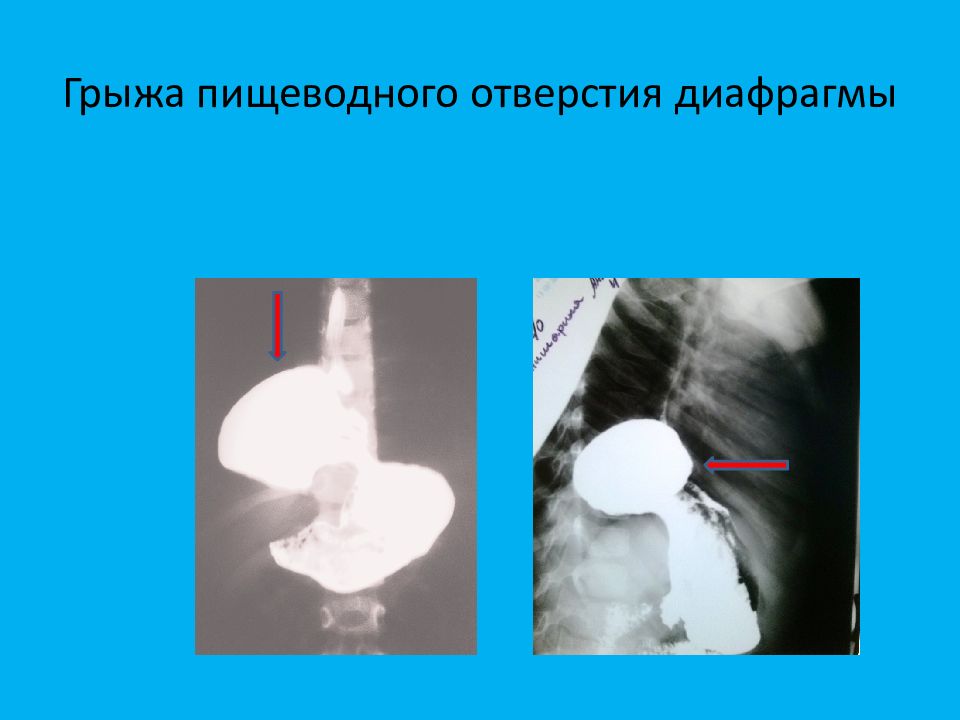 Грыжи пищеводного отверстия диафрагмы презентация по хирургии