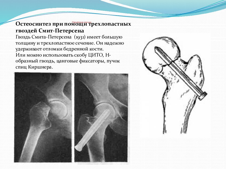 Остеосинтез бедренной. Перелом шейки бедра остеосинтез. Экстрамедуллярный остеосинтез бедра. Металлоостеосинтез шейки бедра.