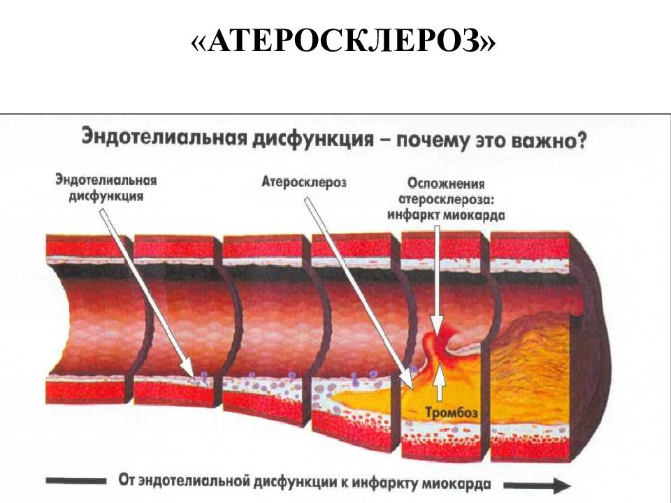 Атеросклероз картинки для презентации