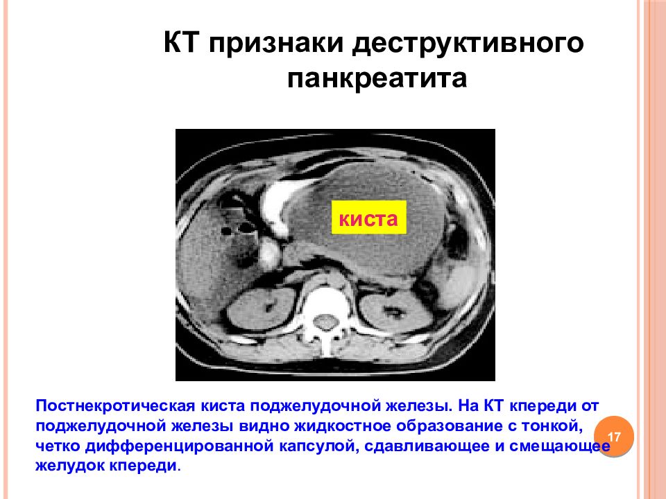 Кт картина острого панкреатита