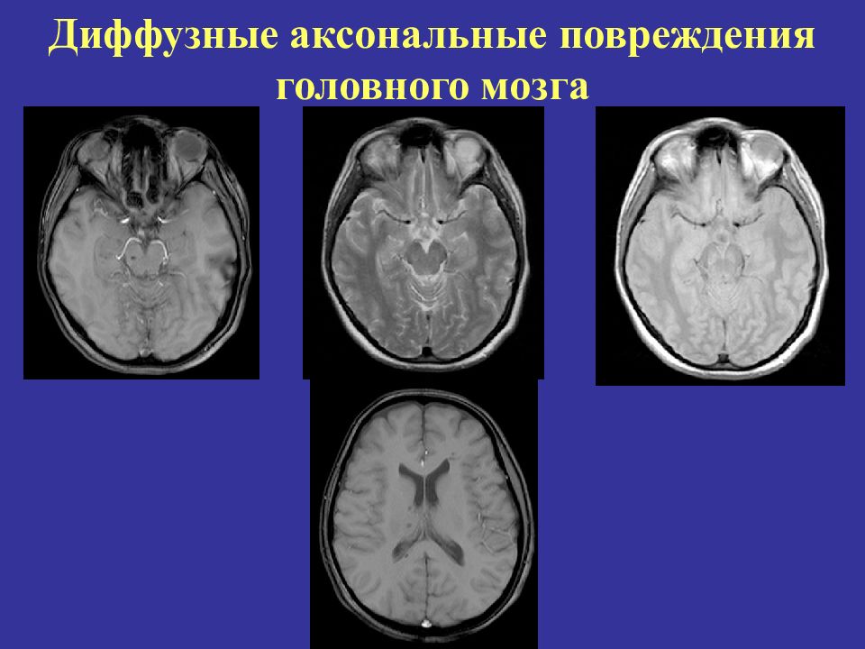 Диффузная травма. Аксональные повреждения головного мозга. Диффузное повреждение головного мозга. Диффузно аксональные повреждения головного мозга. Диффузные аксональные повреждения головного мозга мрт.