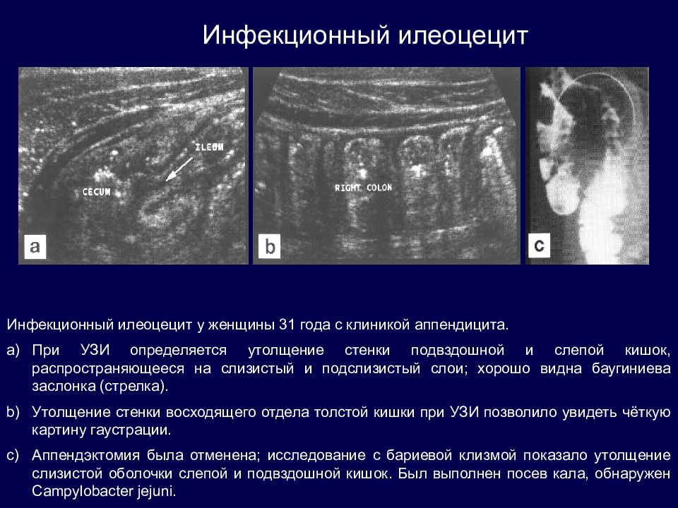 Пневматизация кишечника на узи