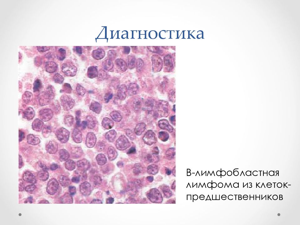 Б клеточная. Крупноклеточная лимфома гистология. Крупноклеточная неходжкинская лимфома гистология. Неходжкинская лимфома гистология. Лимфосаркома неходжкинская.