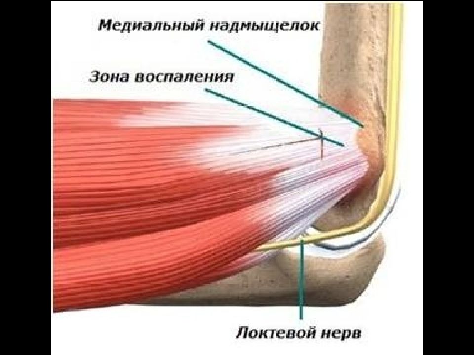 Эпикондилит плечевого сустава. Медиальный эпикондилит анатомия. Латеральный эпикондилит локтевого. Медиальный эпикондилит локтевого. Латеральный эпикондилит рентген.