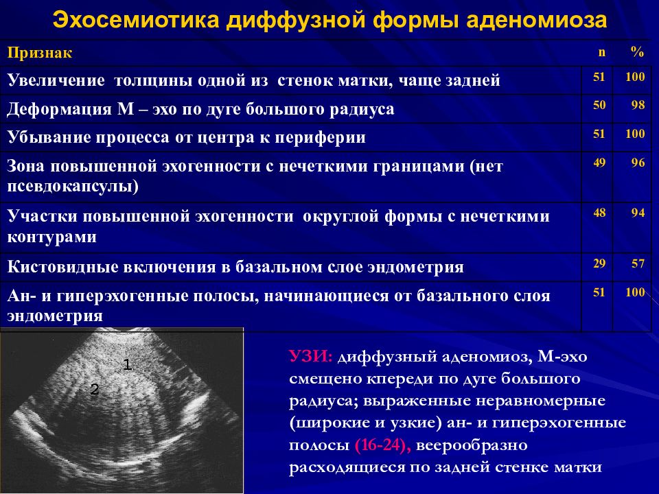 Эндометрия стенок матки. Аденомиоз 1 степени диффузная форма. Критерии аденомиоза на УЗИ. Диффузный эндометриоз матки УЗИ. Диффузная форма аденомиоза УЗИ.