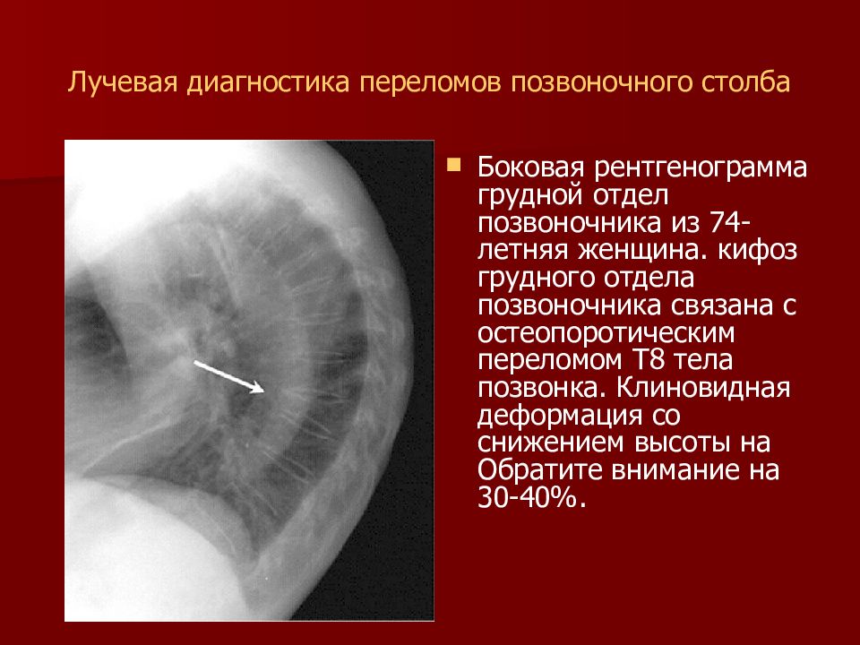 Лучевая диагностика это. Измерение угла кифоза грудного отдела. Грудной кифоз степени рентген. Грудной кифоз измерения рентген. Кифоз лучевая диагностика.