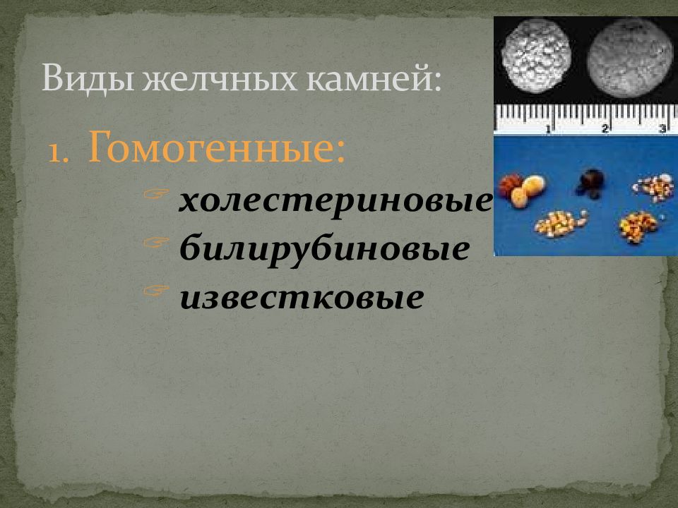 Виды желчных камней. Классификация желчных камней. Виды билирубиновых камней. Индекс Хома виды желчных камней