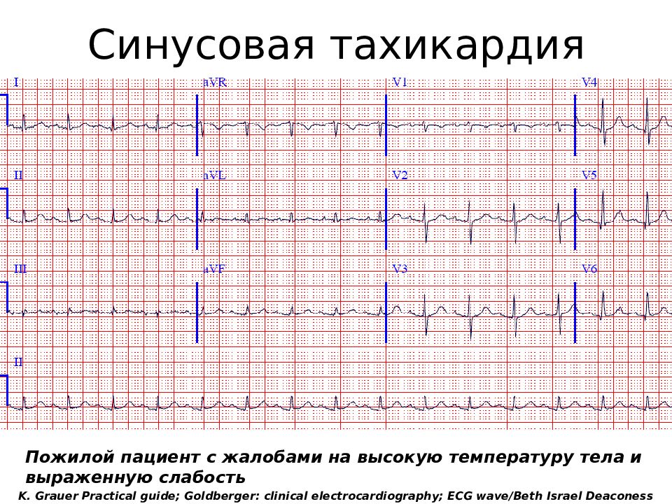 Синусовый ритм у взрослого. Синусовая тахикардия ЭКГ расшифровка. ЭКГ при синусовой тахикардии. ЭКГ критерии синусовой тахикардии. Синусовая тахикардия у детей на ЭКГ.