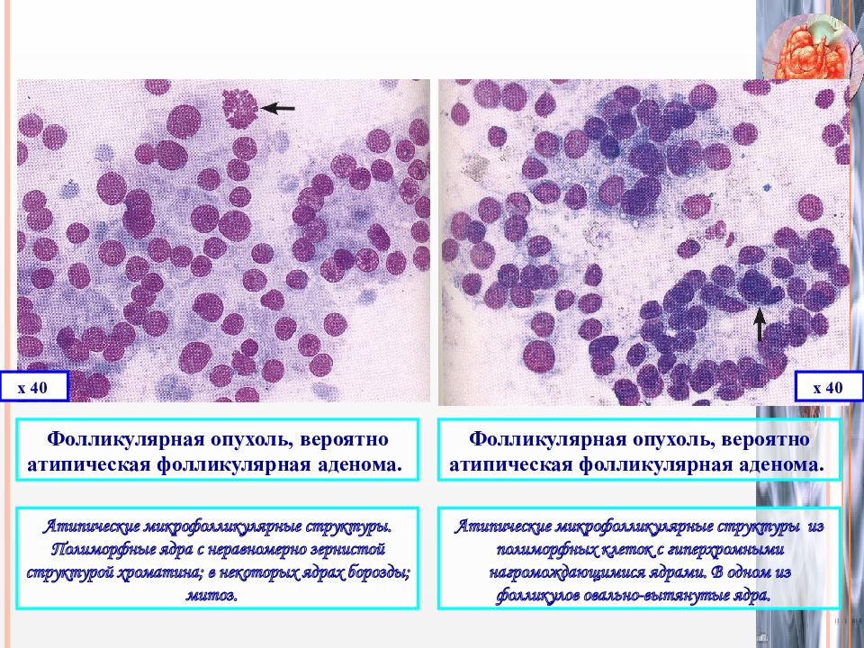 Цитологическая картина фолликулярной в клеточной опухоли щитовидной железы bethesda iv