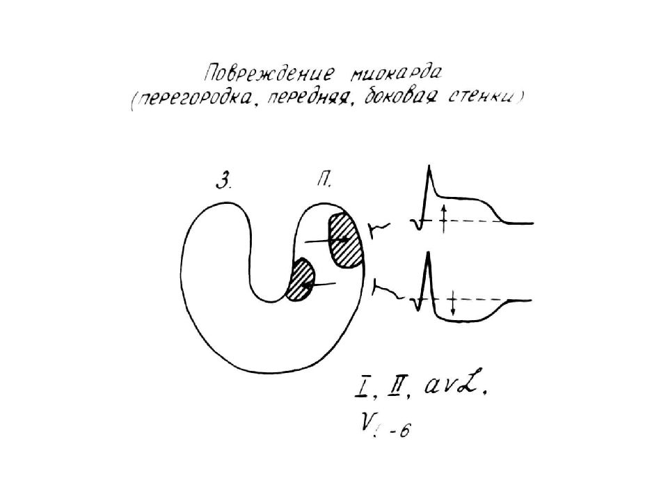 Зубы ковша на ЭКГ схема.