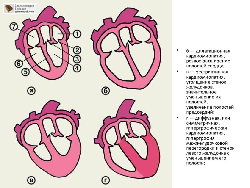 Дилатация левого желудочка что это. Дилатационная кардиомиопатия. Расширение полостей сердца. Дилатационная кардиомиопатия сердца. Утолщенные стенки сердца.