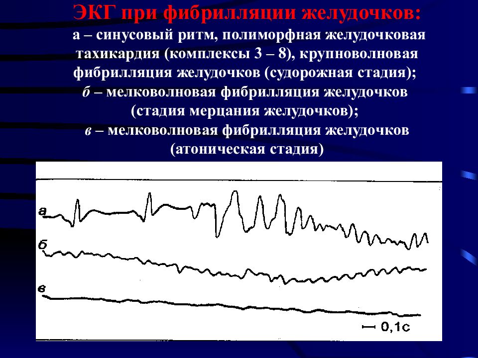 Желудочковый ритм. Крупноволновая фибрилляция желудочков на ЭКГ. Мелковолновая фибрилляция желудочков. Мелковолновая фибрилляция желудочков ЭКГ. Фибрилляция предсердий и желудочков.