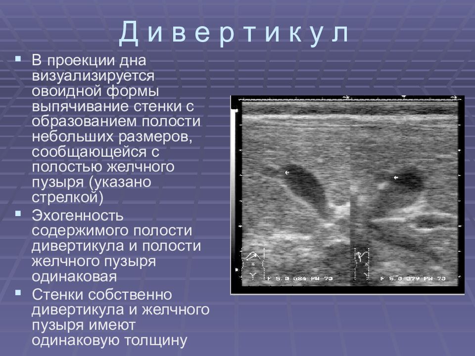 Обобщенная эхографическая картина рака желчного пузыря может быть представлена