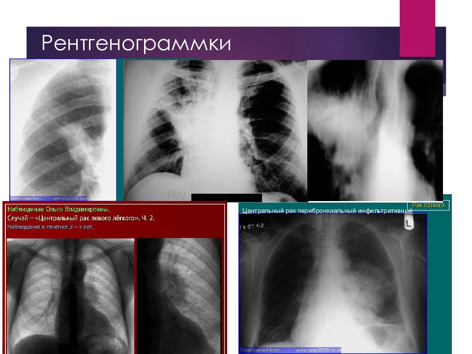 Центральный рак легкого презентация