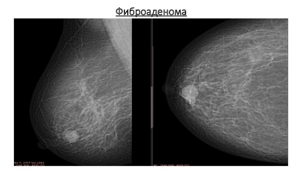 Что такое фиброаденоз молочной железы. Фиброаденома молочной железы маммограмма. Фиброаденома молочной железы маммография. Маммография фиброаденома снимок. Маммография фиброаденома.