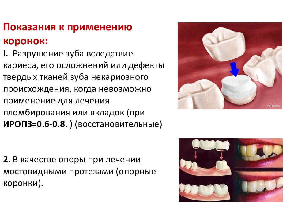 Искусственные коронки презентация