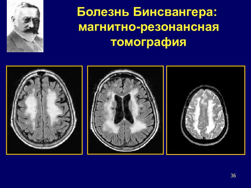 Болезнь мрт. Болезнь Бинсвангера прогрессирующая лейкоэнцефалопатия. Болезнь Бинсвангера мрт критерии. Мрт картина при болезни Бинсвангера.