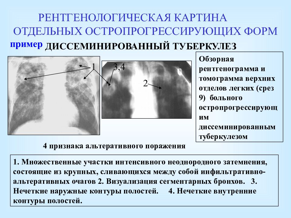 Ампутация корней легких при рентгенологической картине характерна для