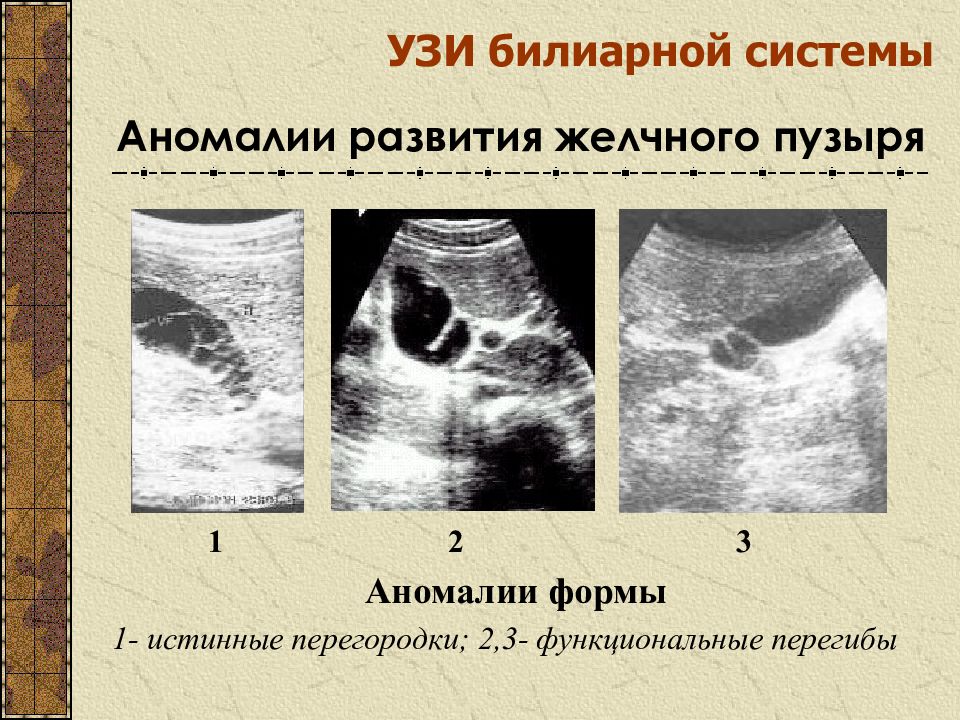 Узи желчного пузыря картинки