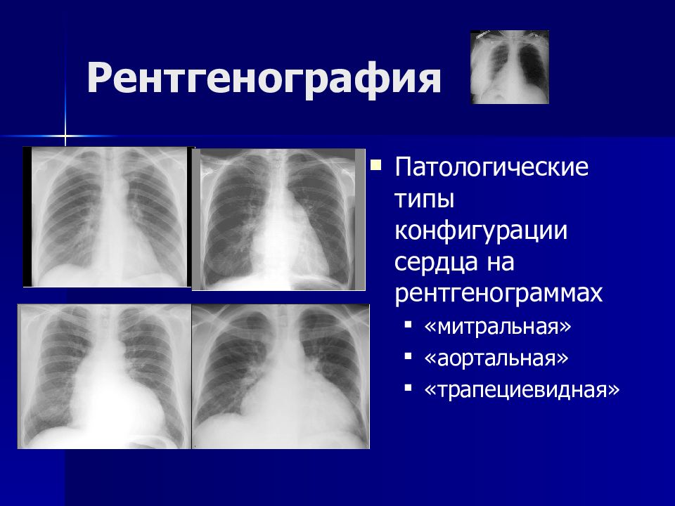 Митральное сердце. Митральная конфигурация сердца рентген. Митральная форма сердца рентген. Аортальная форма сердца рентген. Митральная конфигурация сердца на рентгенограмме.