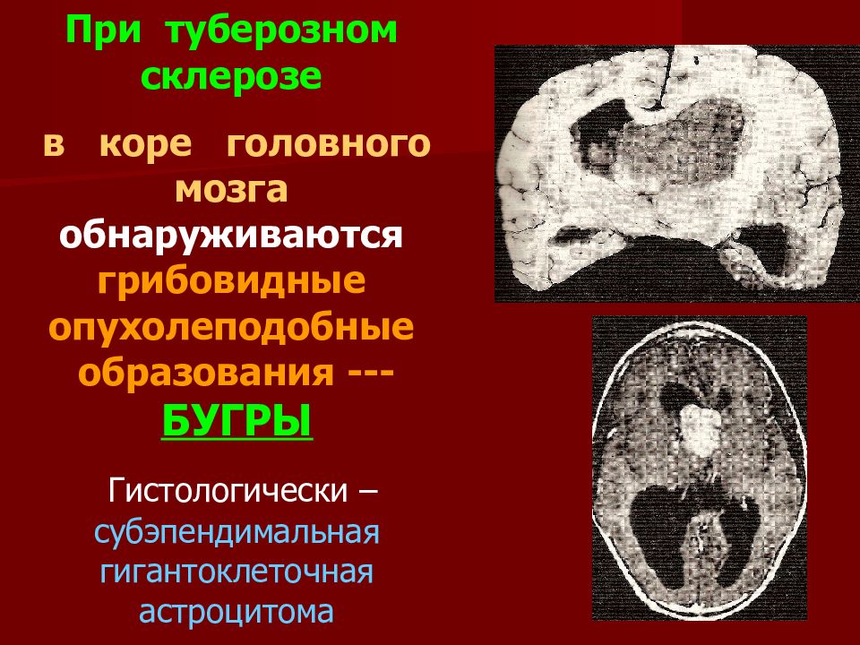 Ангиомиолипома мкб. Опухоли почек классификация. Субэпендимальный узел мрт.