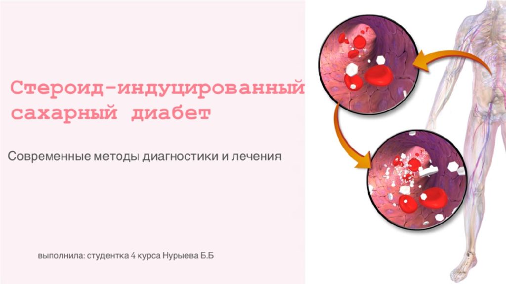 стероидный сахарный диабет