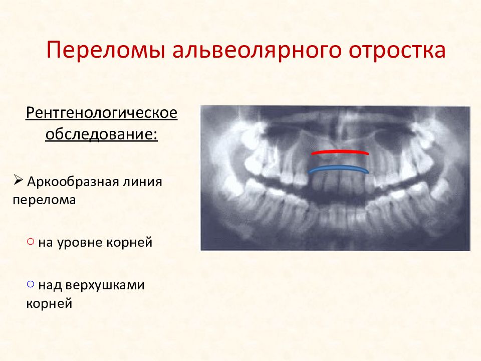 Альвеолярный отросток верхней челюсти. Перелом альвеолярного отростка классификация. Отлом альвеолярного отростка челюсти. Перелом альвеолярного отростка верхней челюсти рентген. Отлом участка альвеолярного отростка.