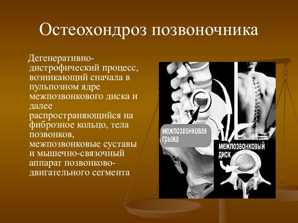 Заболевание позвоночника остеохондроз. Неврологические осложнения остеохондроза позвоночника. Остеохондроз презентация. Остеохондроз позвоночника презентация. Презентация на тему остеохондроз.
