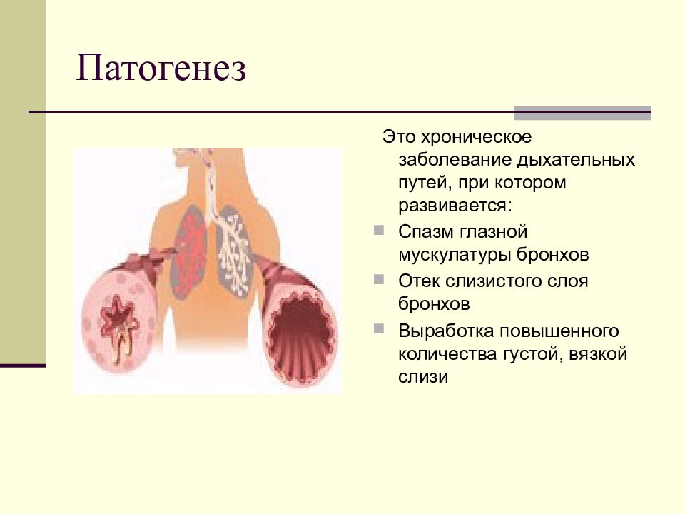 Схема патогенеза бронхиальной астмы