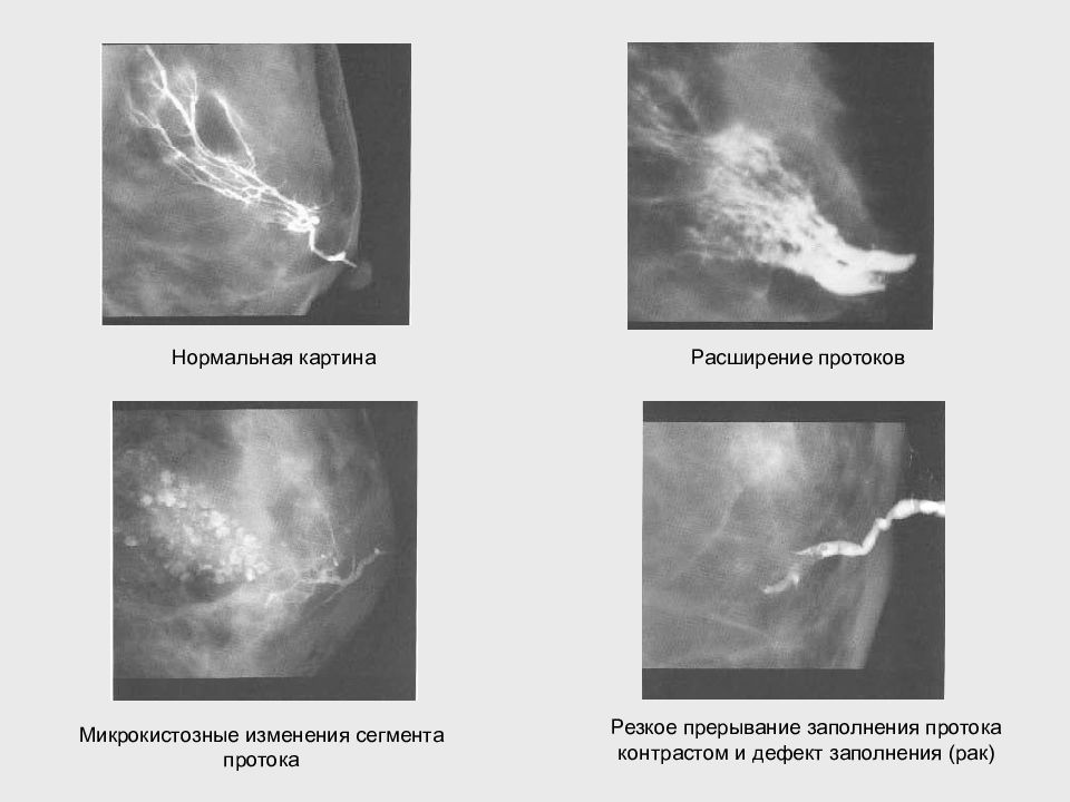 Расширение протоков. Расширенный проток в молочной железе. Млечный проток молочной железы расширен. Расширение протоков на маммограмме. Маммография расширение протоков.